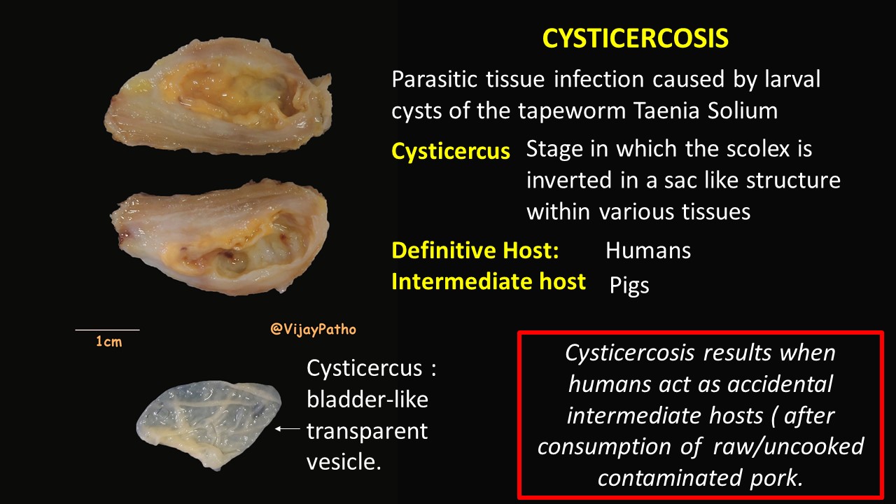 PATHOLOGY OF CYSTICERCOSIS Pathology Made Simple