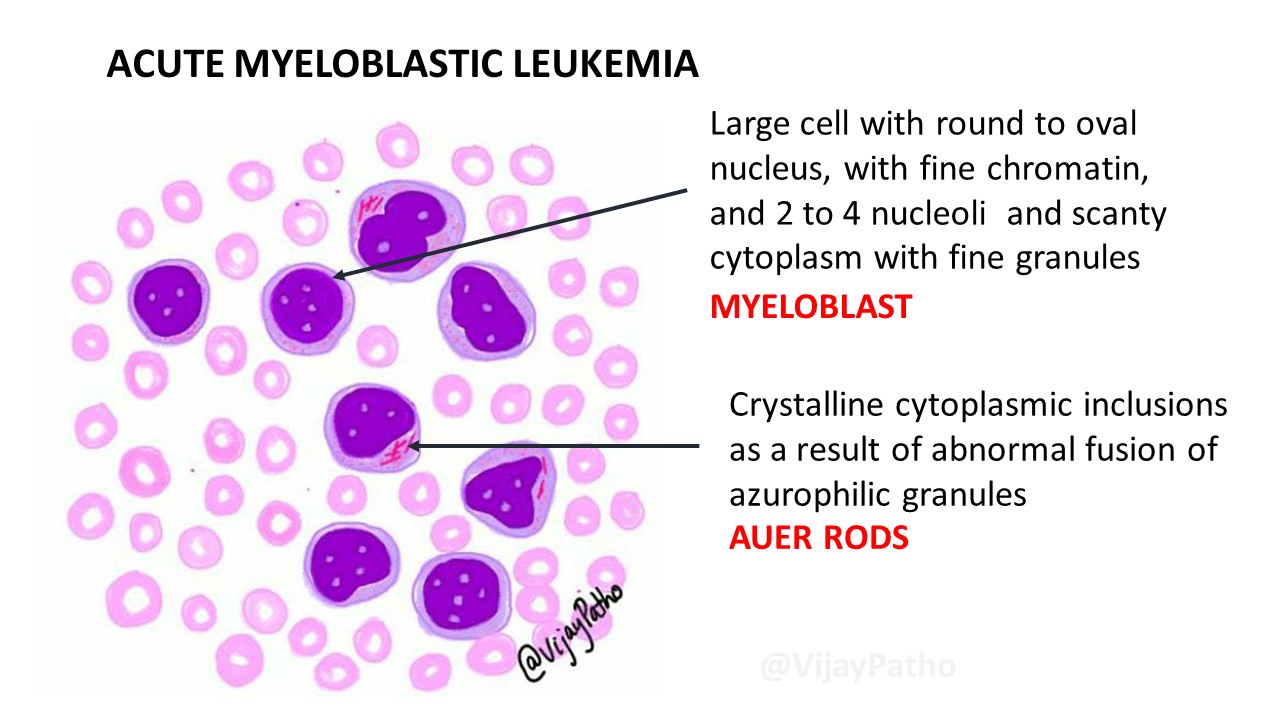 Peripheral smear findings in Leukemia Illustrated Pathology Made Simple