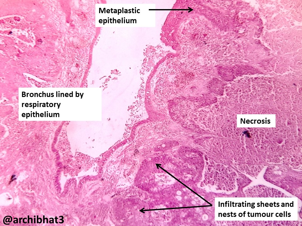Pathology of Bronchogenic carcinoma /squamous cell carcinomalung