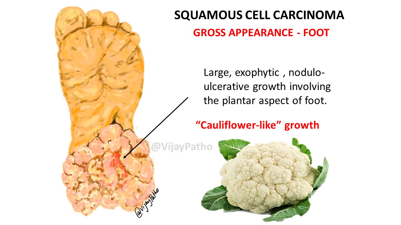 Pathology of SQUAMOUS CELL CARCINOMA Pathology Made Simple