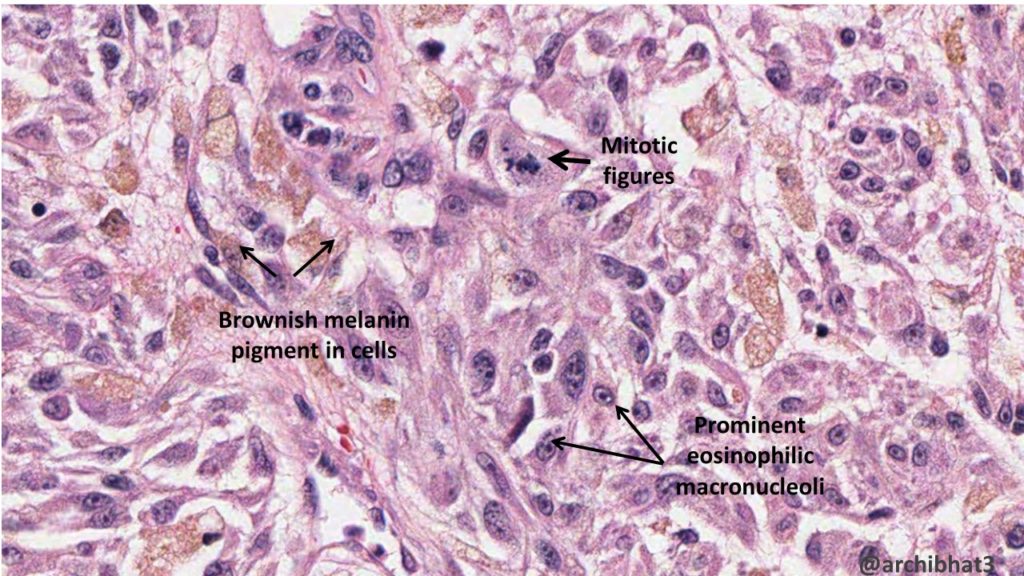 Pathology of Malignant Melanoma Pathology Made Simple