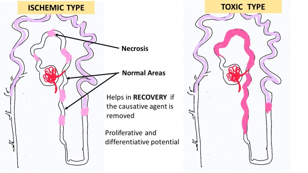 Pathology of Acute tubular injury/necrosis Pathology Made Simple