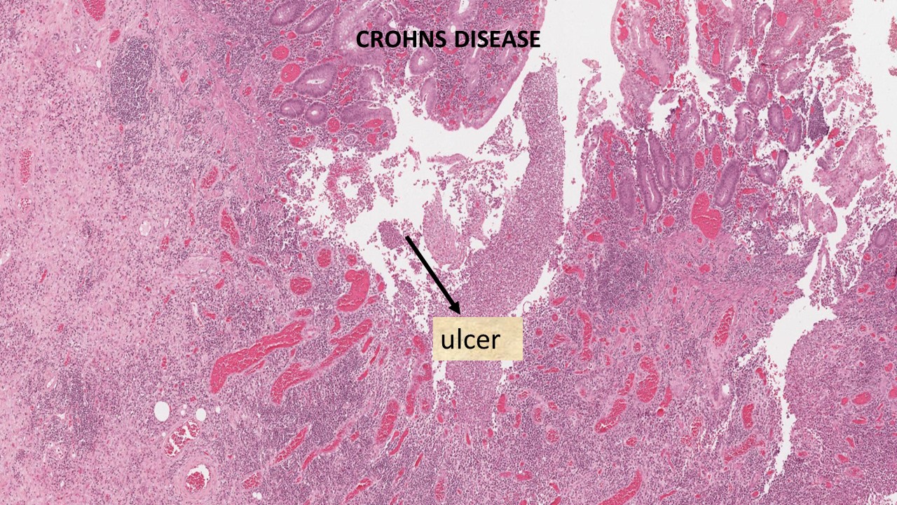 Pathology of Crohn’s Disease Pathology Made Simple
