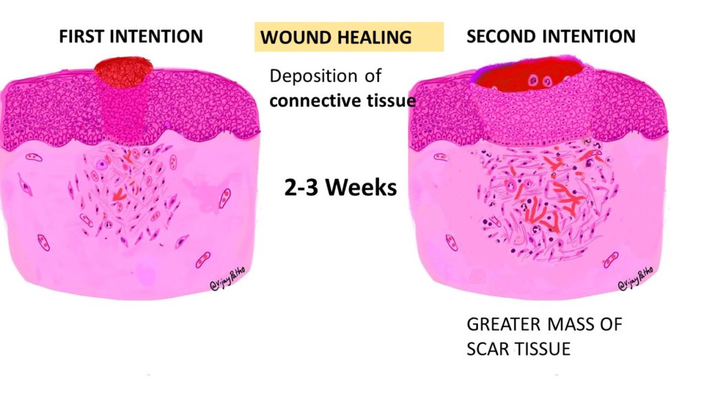 TISSUE REPAIR Wound Healing Pathology Made Simple