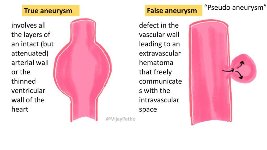 Aneurysms Types, Causes, and Management Pathology Made Simple