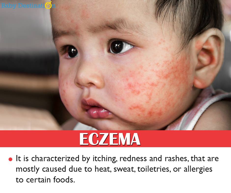 Common Allergies in Babies