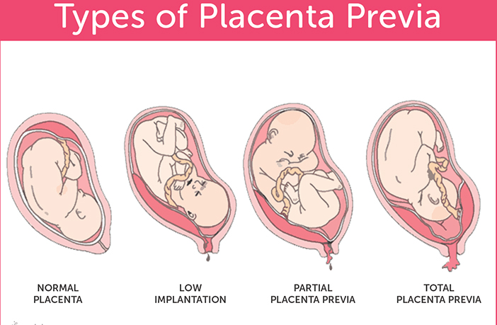 Bleed During Pregnancy Second Trimester Second Trimester How Much