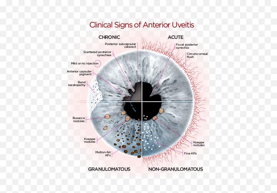 Eye Anatomy Clinical Signs Of Anterior Uveitis Emoji,Eyes Squiggly