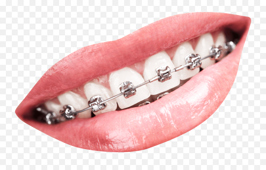 Best Braces Transparent Background Teeth Braces Png Emoji,Brace Face