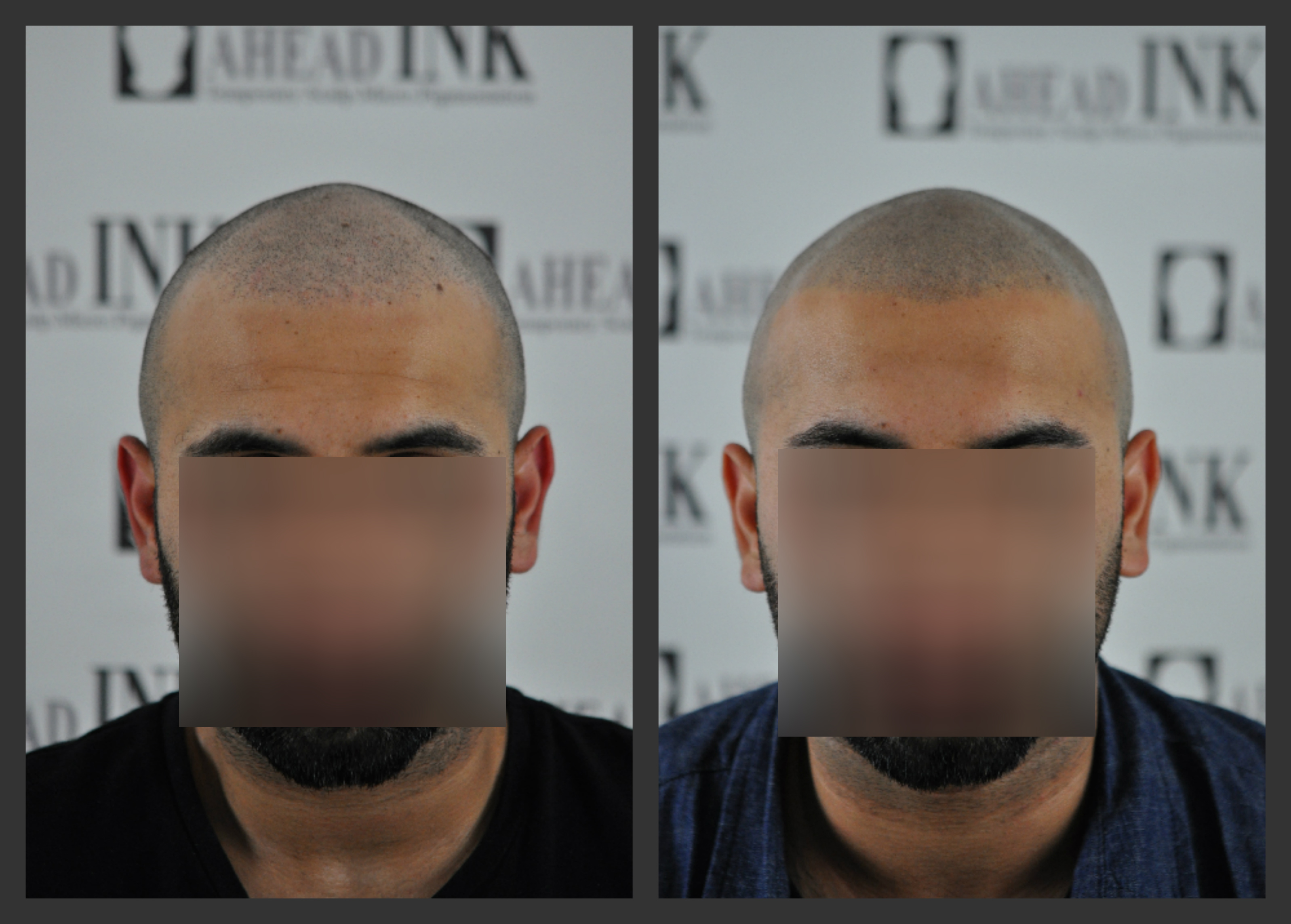 FUE Meet SMP! Scalp Micropigmentation (SMP) Hair Restoration
