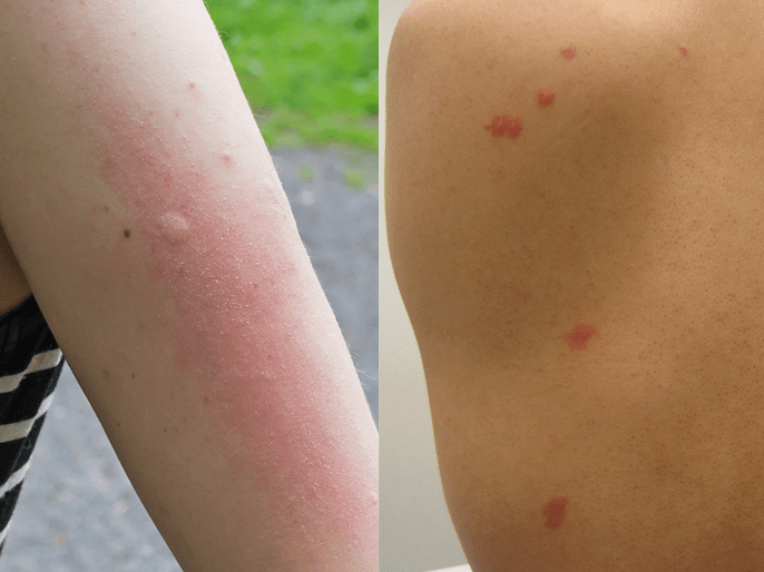 I Hate Mosquitoes Reddit trabalhecentralsonic