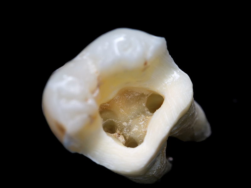 Why a Root Canal Is Not Something To Fear The Dental Design Center