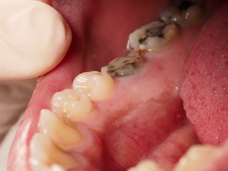 How to Prevent Tooth Decay In Monkton Hereford Dental Health