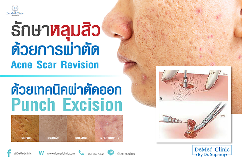 รักษาหลุมสิวด้วยการผ่าตัด Acne Scar Revision ด้วยเทคนิคผ่าตัดออก Punch