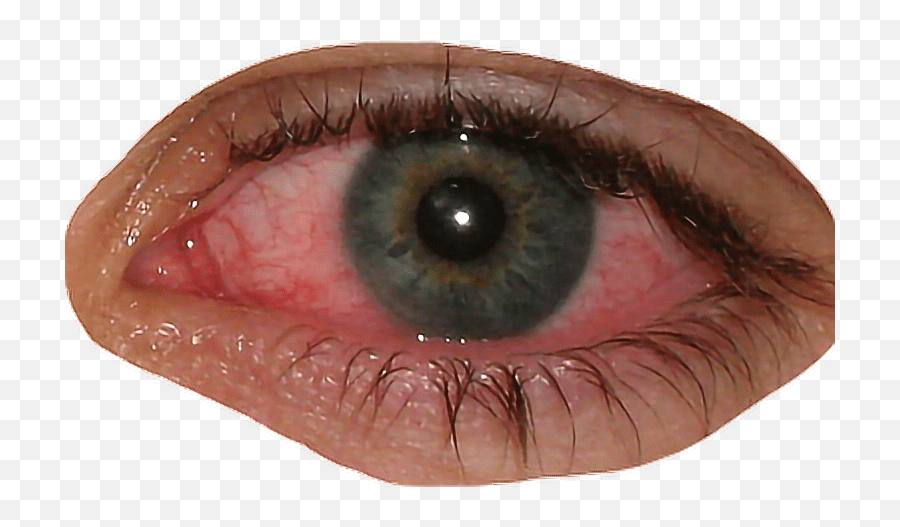 Eye Bloodshot Blood Redeye Sticker White Pus In Corner Of Eye Png,Red