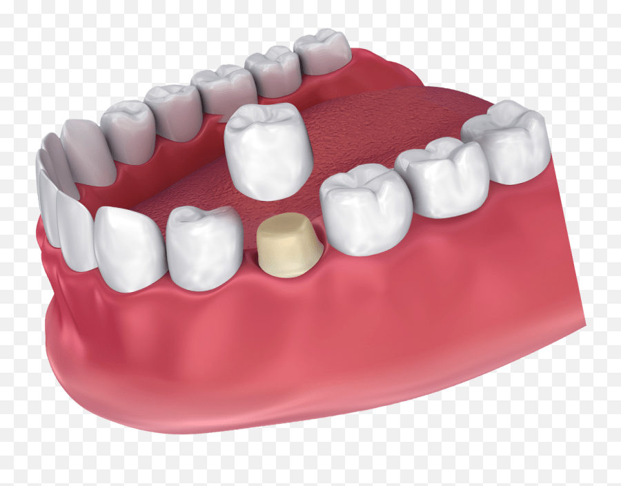 Dental Crowns Foods And Drinks To Avoid Jackson Ms Dental Crown Png,Crowns Png free