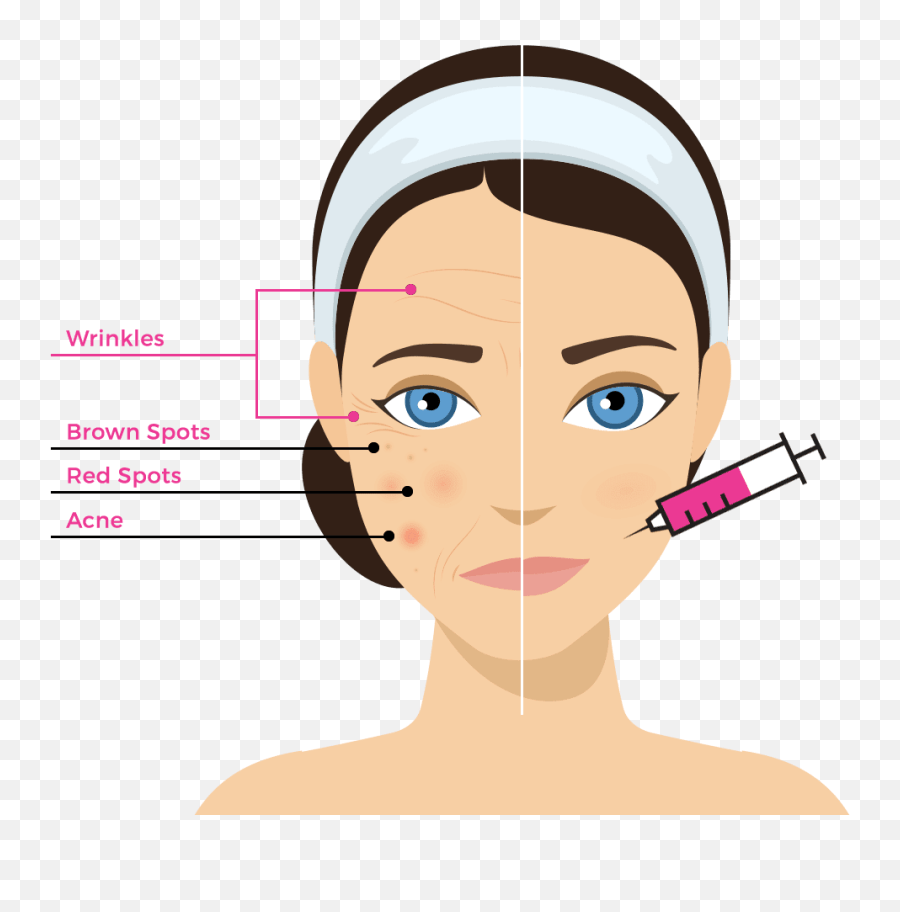 Laser Hair Removal Geneva Il Spider Veins Treatment For Women Png