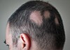 Pattern hair loss could be due to gut bacteria