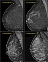 What mammogram images tell us about breast cancer risk