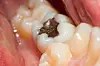 Are mercury dental fillings really that dangerous?