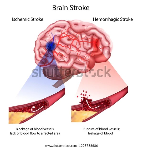 Anatomy Of Stroke Anatomy Book