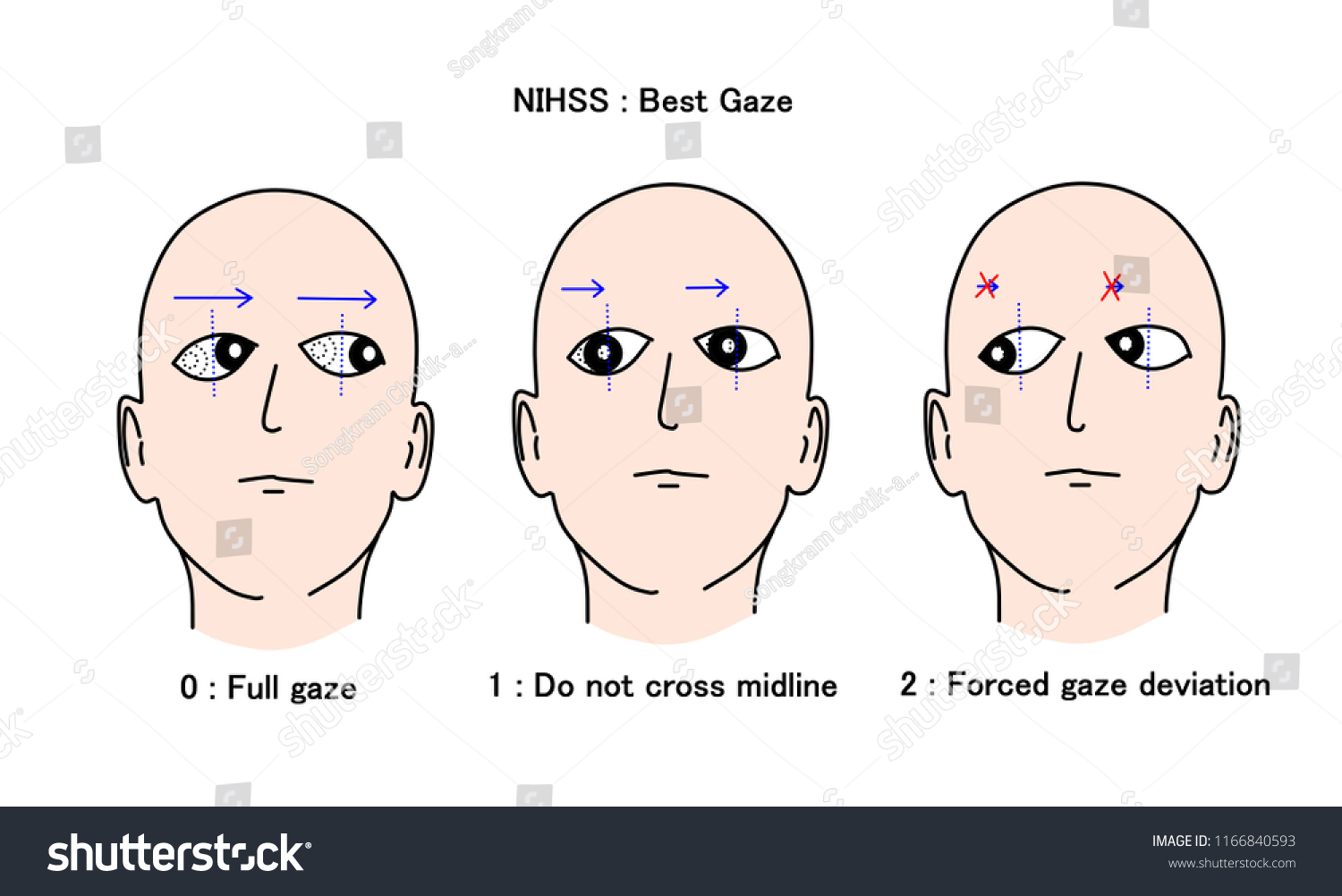 Gaze preference is the important sign in Royalty Free Stock Photo 1166840593