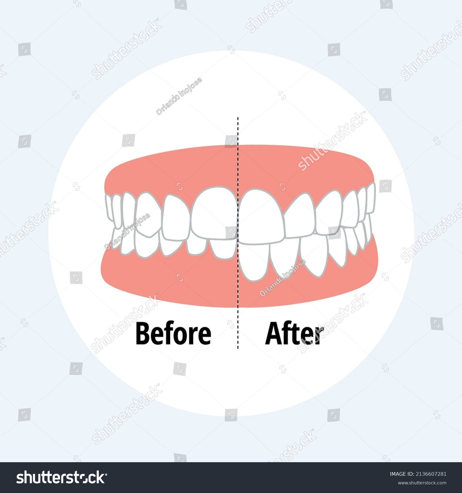 Malocclusion Overbite. Dental problem vector Royalty Free Stock