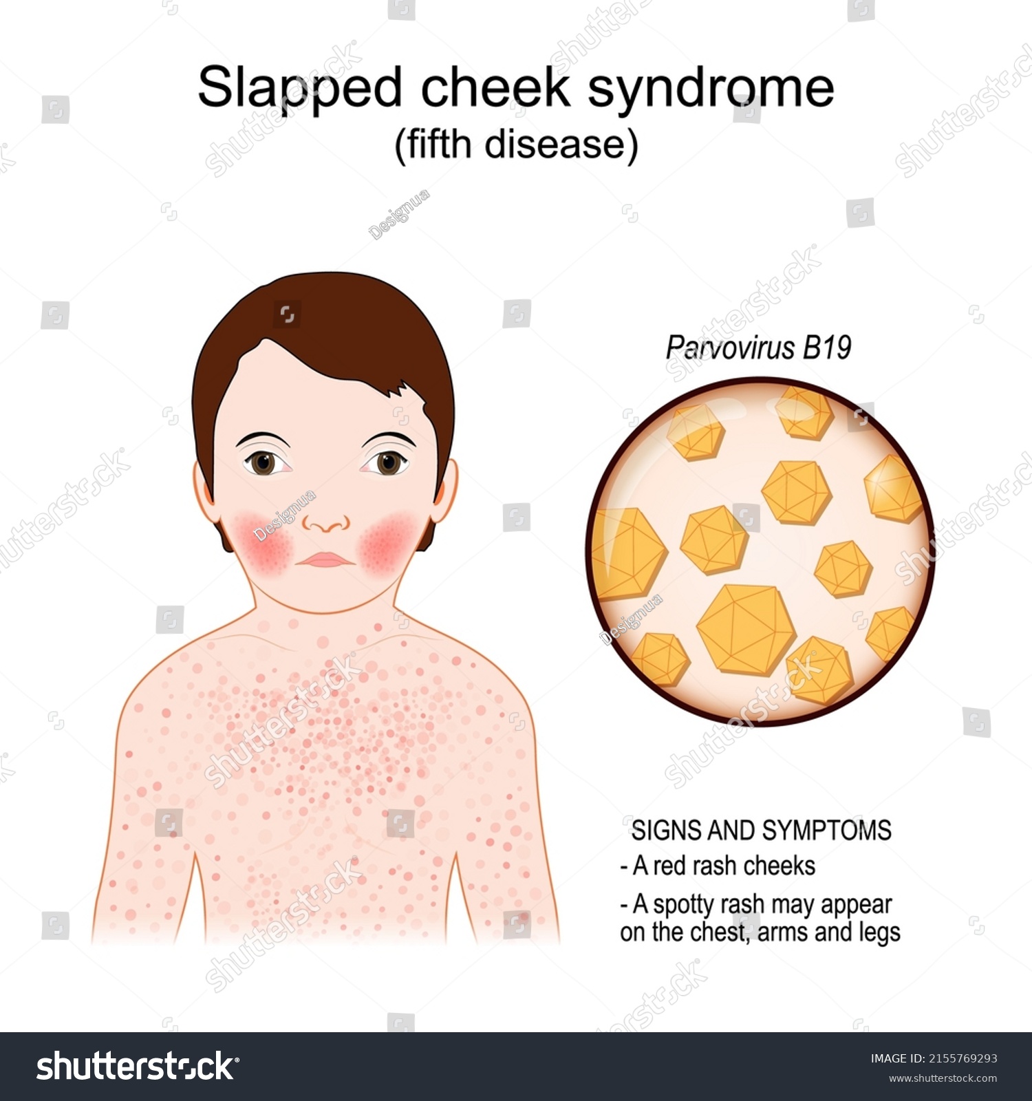 Fifth disease. Signs and symptoms. child has Royalty Free Stock