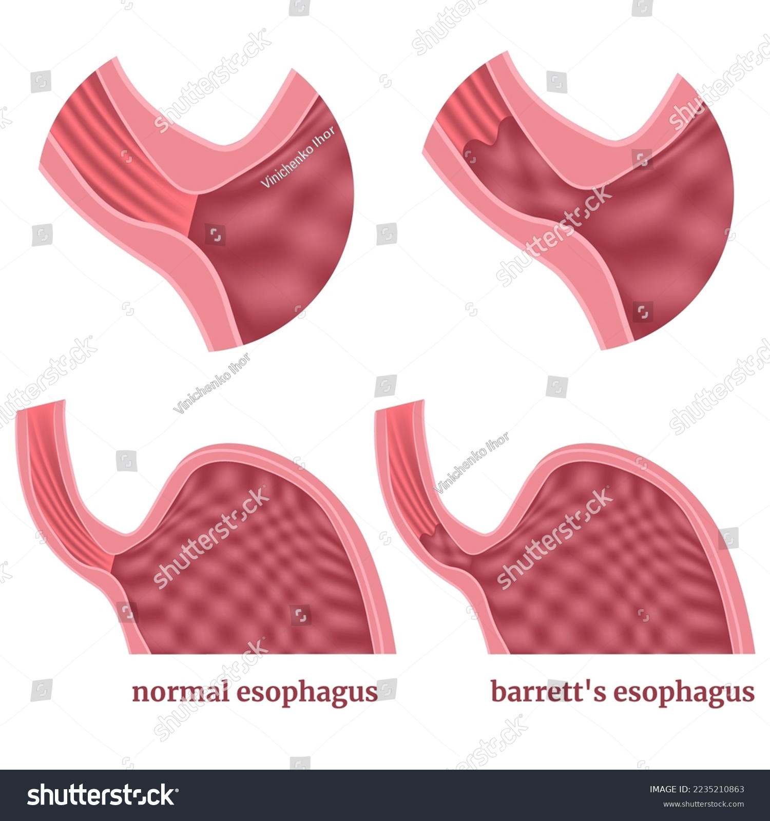 Barrett's esophagus. Diagram of stomach with Royalty Free Stock Vector 2235210863