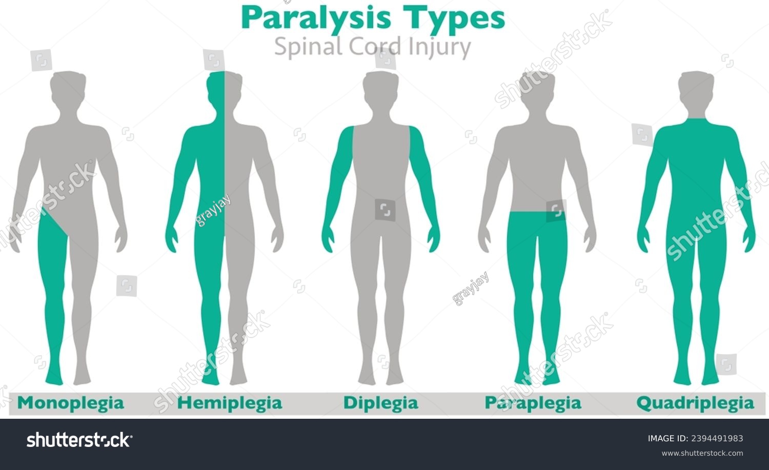 Paralysis types, spinal cord injury. Hemiplegia, Royalty Free Stock