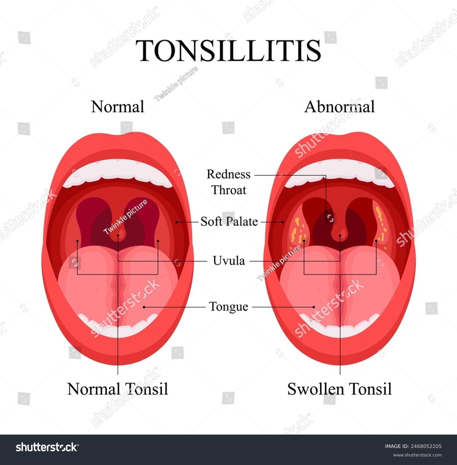 Diagram of Tonsillitis Causes, Normal Tonsils - Royalty Free Stock