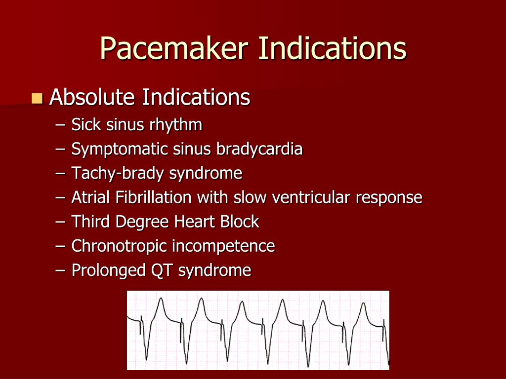 PPT Pacemakers and Implanted Defibrillators PowerPoint Presentation