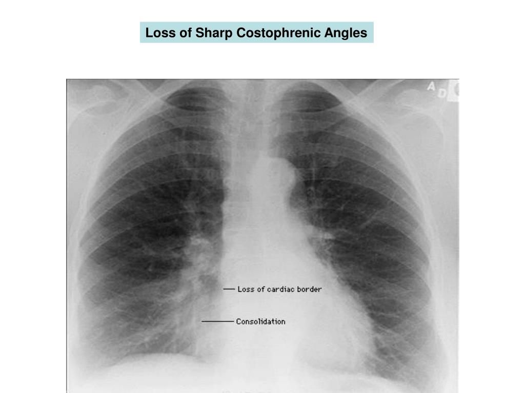 PPT Basic Chest XRay Interpretation PowerPoint Presentation, free