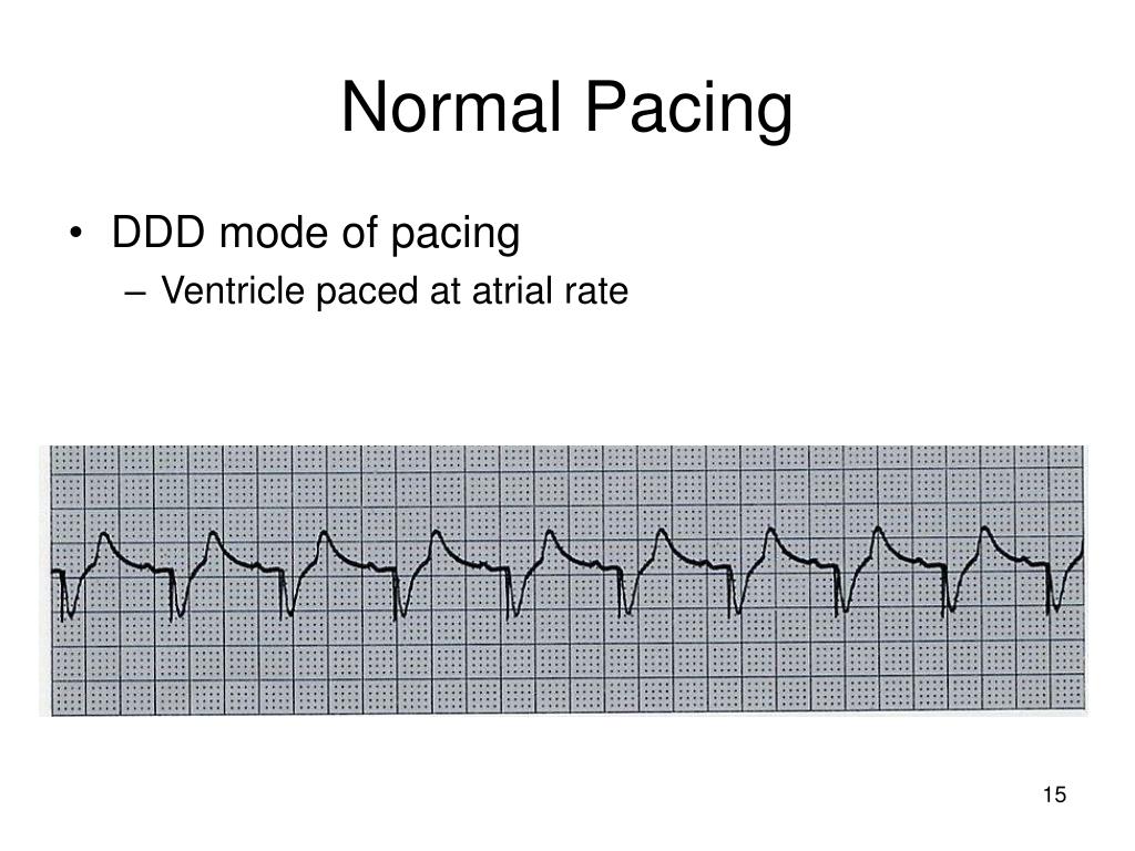 PPT Temporary Pacemakers PowerPoint Presentation, free download ID