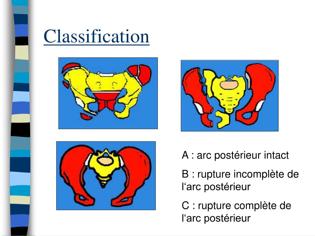 PPT Les Fractures de C ôtes Les Fractures du Bassin Les Fractures du