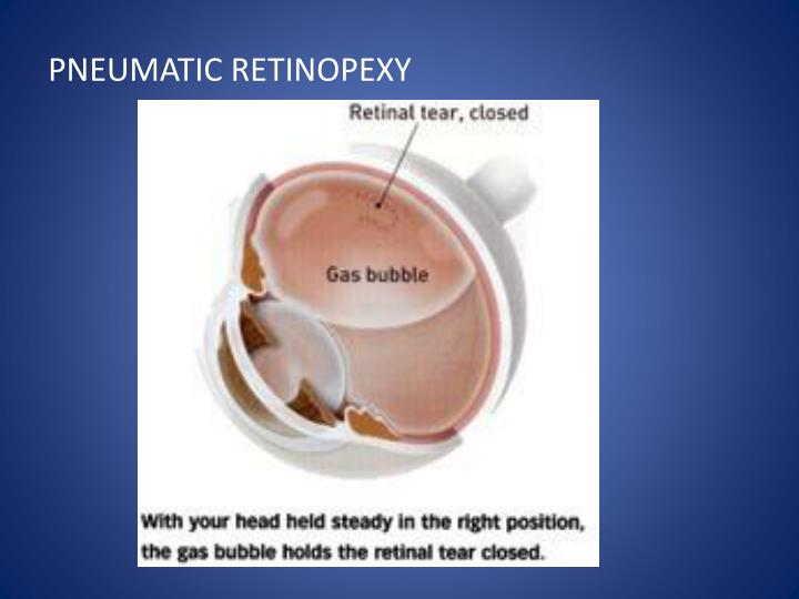 PPT RETINAL DETACHMENT PowerPoint Presentation ID1103859