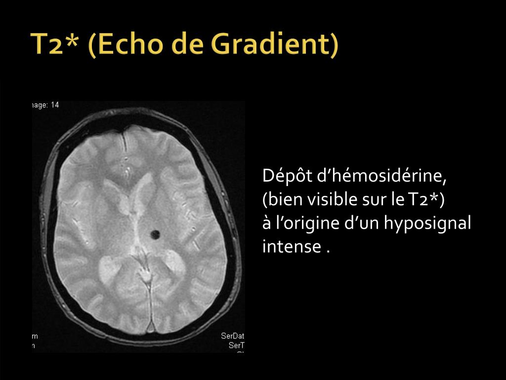 PPT ARTEFACTS en IRM PowerPoint Presentation, free download ID1106740