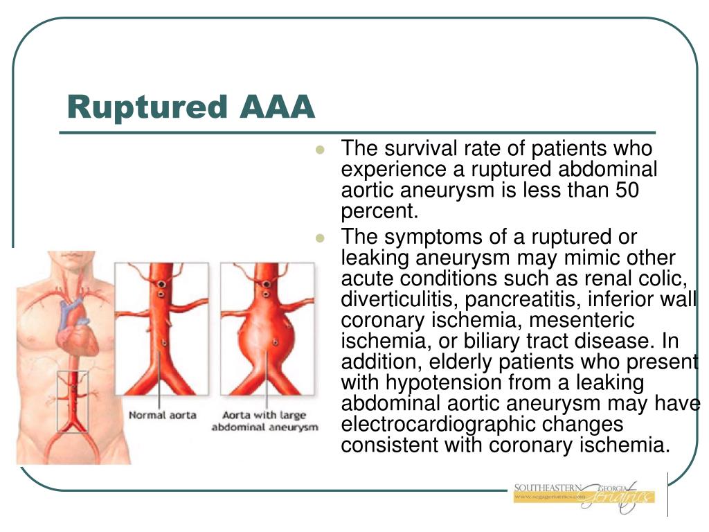 PPT Acute Abdominal Pain in a Geriatric An Emergency Medicine