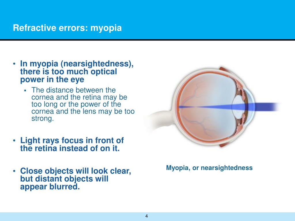 PPT Refractive Lens Exchange PowerPoint Presentation, free download ID1133976