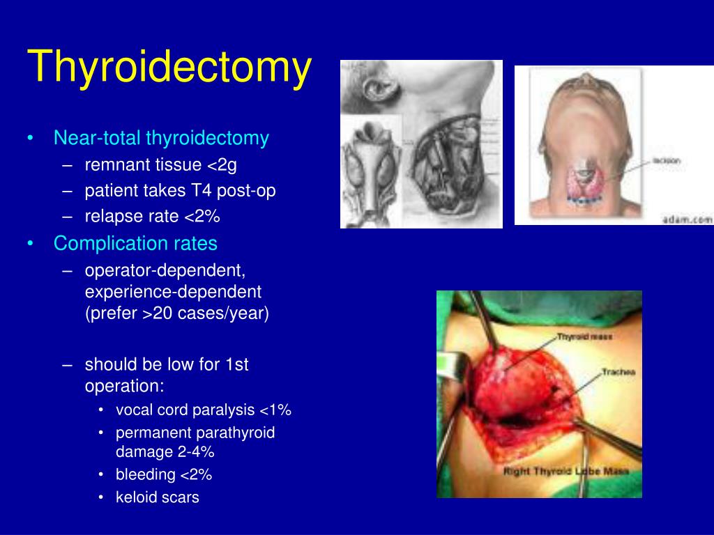 PPT Thyroid disease PowerPoint Presentation, free download ID1147073