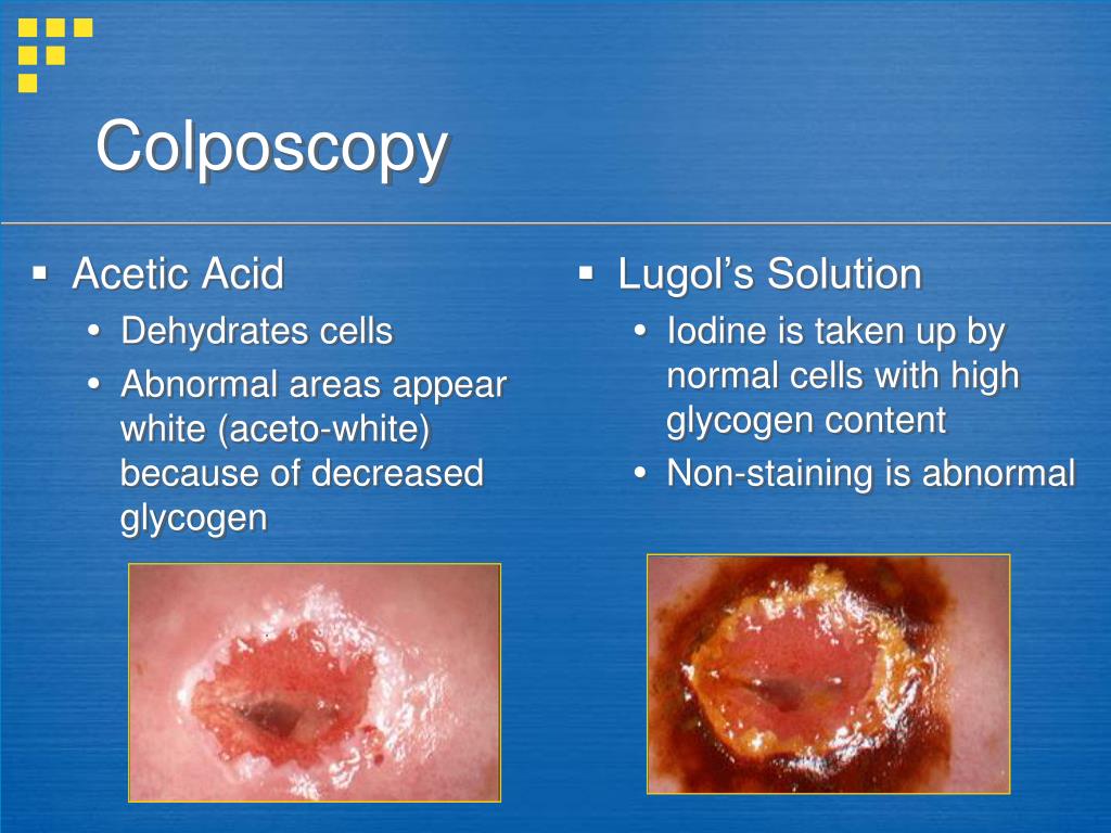PPT Management of Abnormal Pap Smears and Cervical Dysplasia