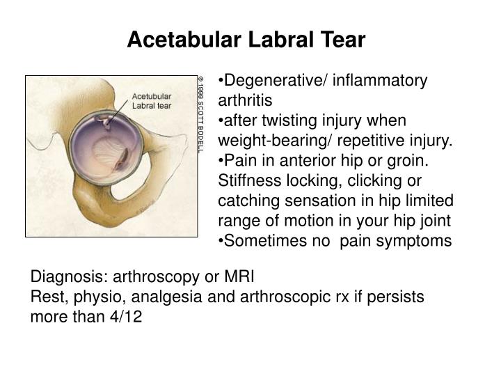 PPT Trochanteric Bursitis PowerPoint Presentation ID1209260