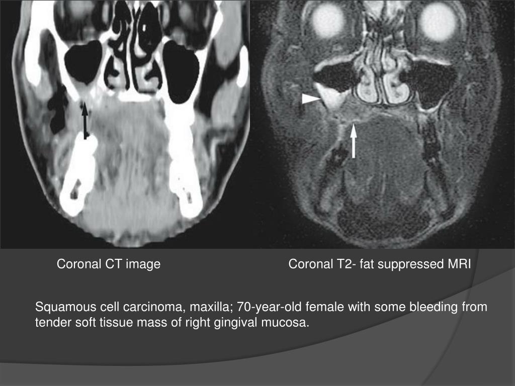 PPT Malignant Jaw tumors PowerPoint Presentation, free download ID