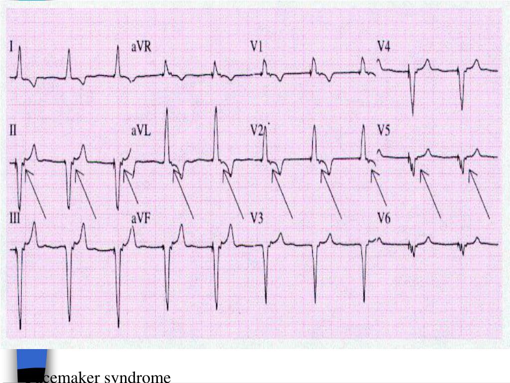 PPT Pacemakers and Internal Cardiac Defibrillators PowerPoint