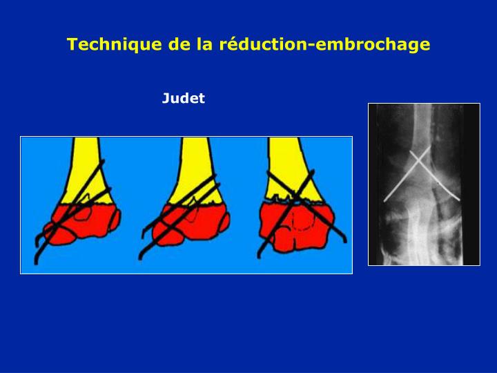 PPT Fractures du COUDE PowerPoint Presentation ID1232037