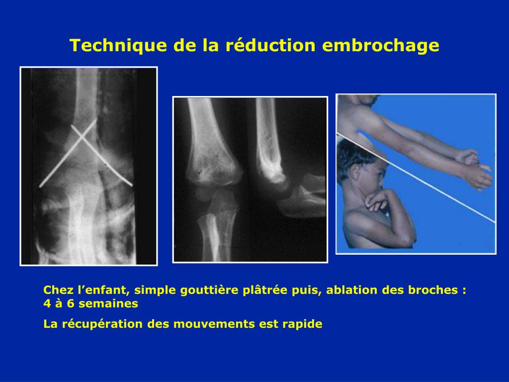 PPT Fractures du COUDE PowerPoint Presentation, free download ID