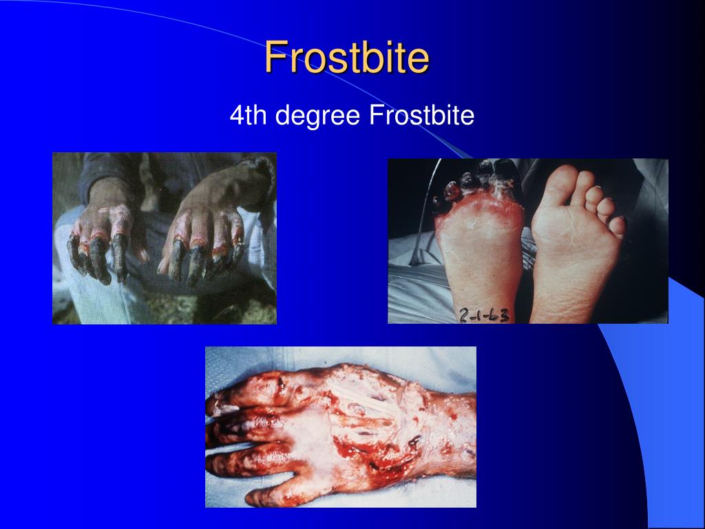 PPT COLD WEATHER INJURY PREVENTION IN AFGHANISTAN PowerPoint