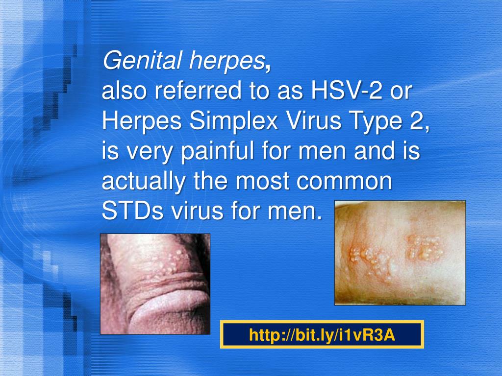 PPT male genital herpes remedy pictures photos PowerPoint