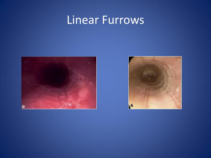 PPT Overview of Eosinophilic Esophagitis PowerPoint Presentation ID