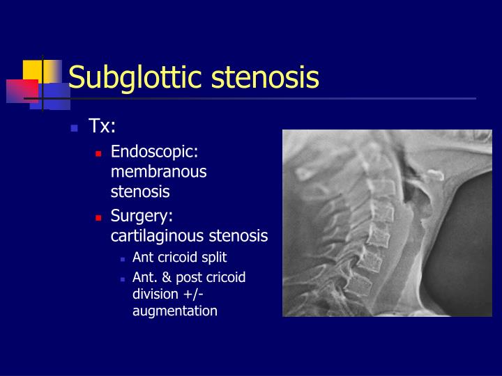 PPT Diseases of the Larynx PowerPoint Presentation ID1255018